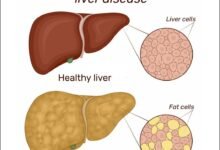 how to cure fatty liver with home remedies