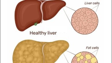 how to cure fatty liver with home remedies