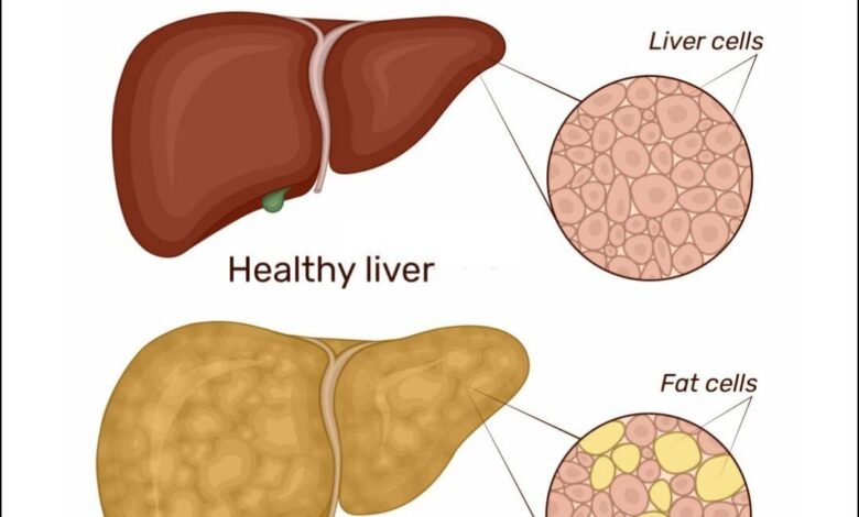 how to cure fatty liver with home remedies