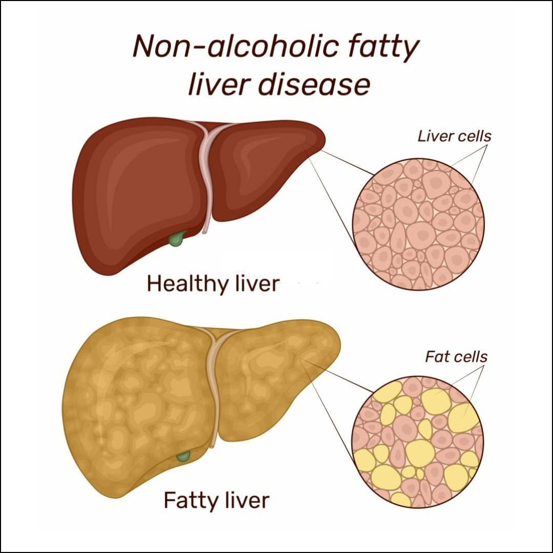 how to cure fatty liver with home remedies