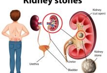 how to treat kidney stones home remedy