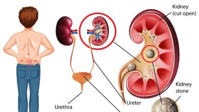 how to treat kidney stones home remedy