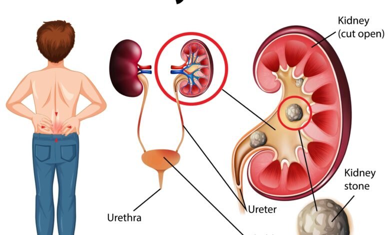 how to treat kidney stones home remedy